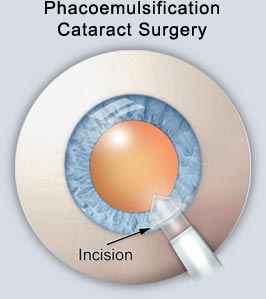 cataract 2.jpg